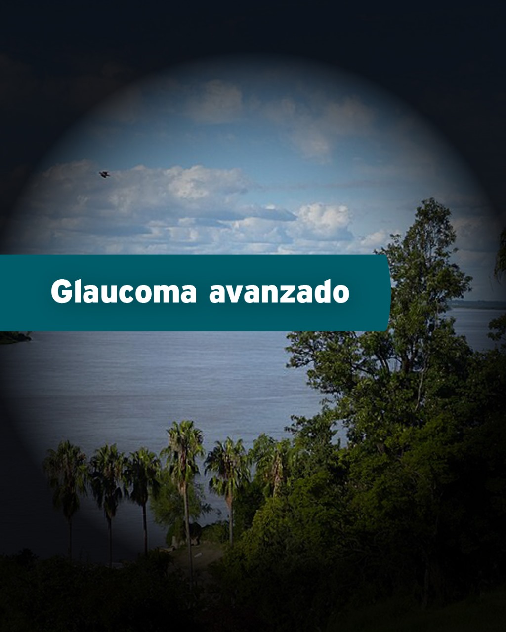 Glaucoma avanzado