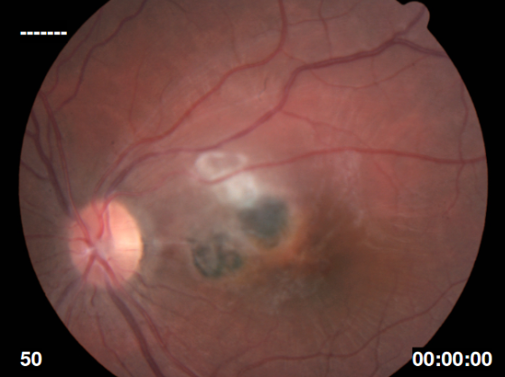Toxoplasmosis ocular – fondo de ojo
