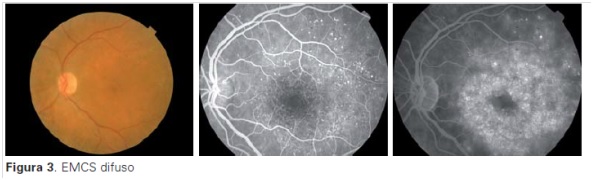 Retinografía y angiografía de edema macular