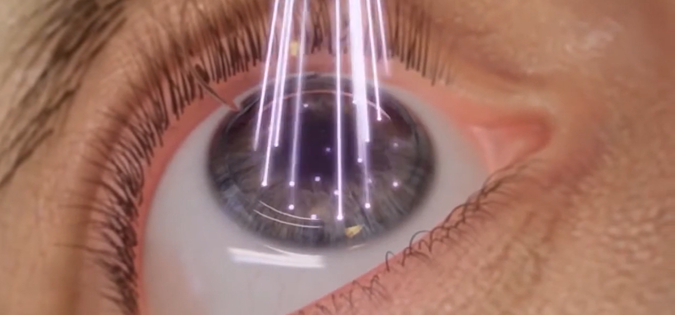 Cirugía refractiva con láser — Instituto Santa Lucía Paraná