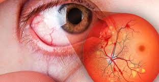 Nuevos avances en retinopatía diabética: investigación liderada por el Dr. Luciano Magurno fue presentada en ARVO 2026 retinopatia 3